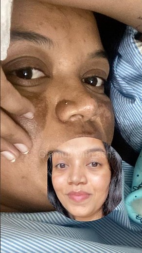 बुरी Condition #pigmentationremedy #melasma #hyperpigmentation #झाइयां