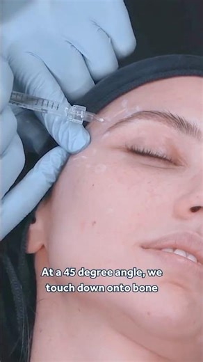 Evidence-Based 'One Up, One Over' Temple Filler Injection Technique 💎 Alex, 39, GEM© Case Study