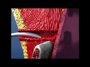 Chest drain (Tube thoracostomy)