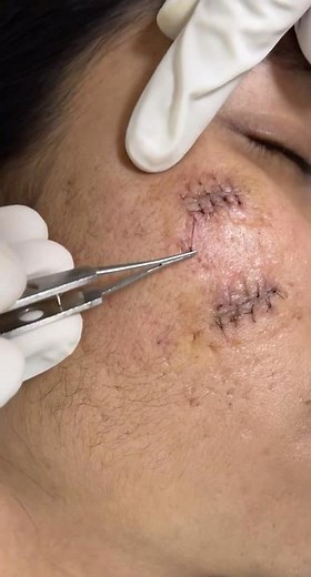 Rigth and easy way of removing stitches | Simple suture removal technique