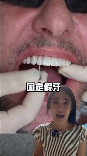 什麼是All On Four全口重建，固定式假牙雖好咬但有一個大缺點#植牙#全口重建#allon4dentalimplants#allon6dentalimplants