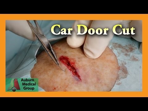 Deep Leg Laceration | Auburn Medical Group