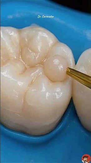 Colocación de resina dental, proceso completo paso a paso, Dra. Fanny Valera odntóloga Cartagena