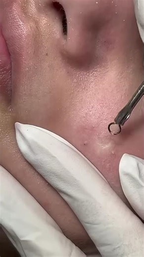 Acne, Zit & Pimple Removal | Blackhead Extraction | Abscess Drainage | Cyst Popping #shorts #2