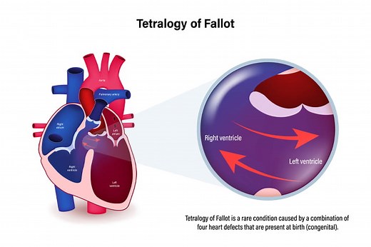 Long-Term Management of Right Ventricular Outflow Tract Dysfunction in Repaired Tetralogy of Fallot