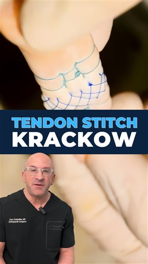 Cory Calendine MD on Instagram: "Krackow stitch: 40 Years of Tendon Repair . First introduced by Dr. Ken Krackow (1986) this locking loop tendon-ligament suture technique advanced how surgeons approached tendon repair. The technique employs 2+ locking loops inserted into each side of the tendon, creating a biomechanically stronger construct - distributing tension evenly across the repair site. Unlike earlier methods, the #Krackow configuration provides exceptional strength for large tendon repai