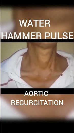 #WATER HAMMER PULSE#Aortic REGURGITATION