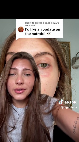 Replying to @chicago_baddie420 #greenscreen hoenst @nutrafol review #nutrafol #hairgrowth
