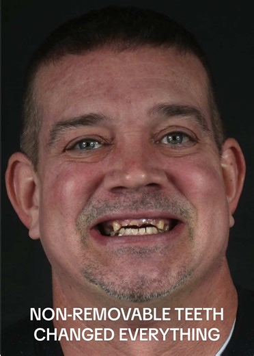 A permanent smile that looks and feels natural. 🦷 With fixed dental implants, he can finally eat, speak, and laugh without holding back — thanks to a custom-designed, non-removable solution delivered the same day. This is what life-changing dentistry looks like. 📍 Texas Dental Implant Center | Houston 📞 (346) 639-2122 📩 DM “TRANSFORM” #FixedDentalImplants #DentalImplants #AllOnFour #HoustonDentist #MissingTeeth