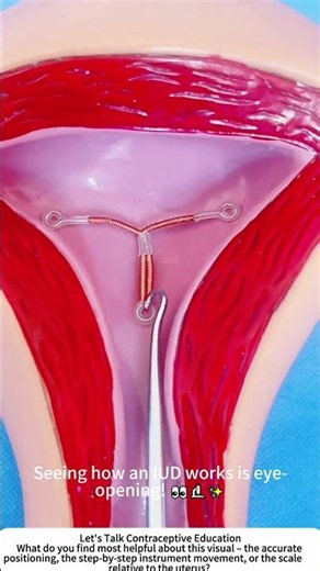 IUD Placement & Removal – Medical Diagram Explained 🩺📊