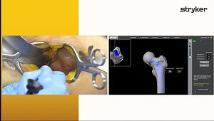 Direct Anterior Approach workflow with Mako Total Hip