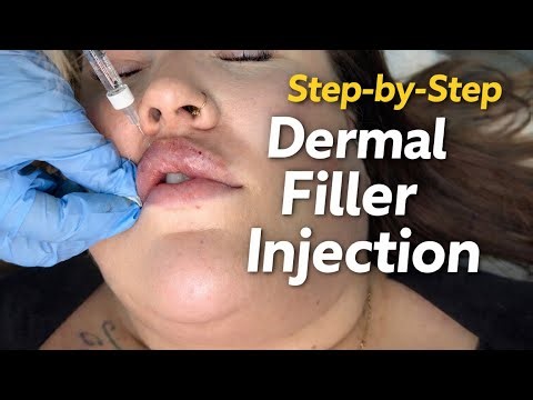 Step-by-Step Dermal Filler Injection | Complete Professional Visual Tutorial