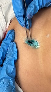 1.2M views · 4K reactions | Insect removed from belly. A doctor removed an insect from a patient's belly. This original video was produced by Rick Lax and Alex Z | Laughs and Hacks | Facebook