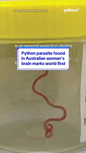 Python Parasite Found in Australian Woman's Brain | World First Discovery