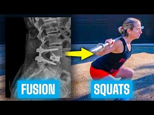 Before & After | Life after Spinal Fusion