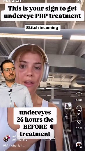 PRP vs. PRF – Warum ich nur noch PRF verwende (besonders unter den Augen!) 👇 Wenn es um empfindliche Regionen wie die Augenpartie geht, reicht „gut“ nicht – hier braucht es langanhaltende Wirkung & maximale Verträglichkeit. Und genau deshalb ist PRF die bessere Wahl als PRP. Warum? Hier kommt der direkte Vergleich – einfach erklärt: 🔬 PRP (Platelet-Rich Plasma): •⁠ ⁠Wird mit einem Medikament (Antikoagulans) hergestellt, das die Blutgerinnung verhindert •⁠ ⁠Durch schnelle Zentrifugation entsteh