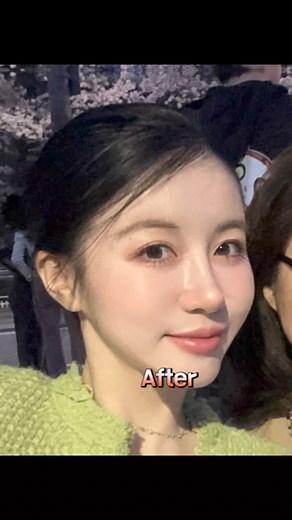 Rhinoplasty | Fat grafting | Thread lifting | Buccal fat lipo | Under eye fat repositioning before/after results ❤️ Over 20 years of experience and heritage you can trust. -WJ Wonjin —————————————————————————— Contact us for a FREE consultation🫶🏼 📲 821029374300 🔗 www.wonjinbeauty.com 📩 english@kwj.co.kr 💬 Kakao|Line ID wonjineng 📮 Instagram DM —————————————————————————— #WJwonjinplasticsurgery #WJ원진성형외과 #wonjinbeauty #koreanskin #rhinoplasty #rhinoplastykorea #subbrowlift #koreanskinclini