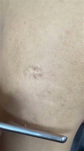 💈Shaved the arm! I actually found some dead skin!