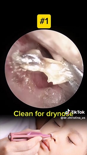 Booger removal to clean dry nose #booger #boogerremoval #drynose #noseclean #sinusclean #sinuses #viralvideo