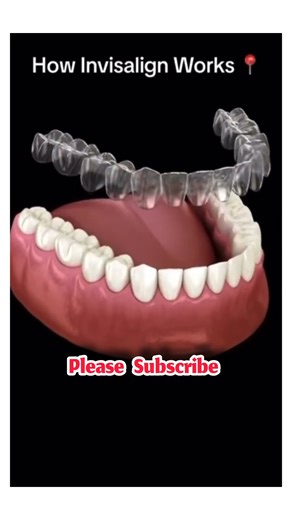 How invisalign works