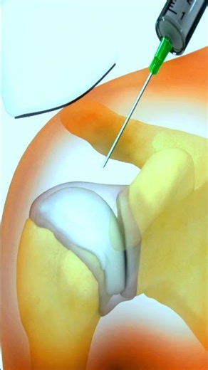 Prolotherapy Explained: Non-Surgical Shoulder Relief 💪