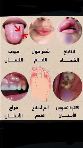 انتفاخ الشفاه :بسبب حساسية الطعاماللدغات واللسعات - التهاب الشفة