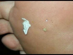 What Really Happens to your Skin - Morgellons Desease - The silent pandemic Aspergillus Fumigatus