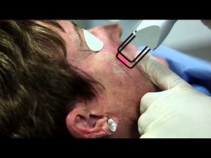 How to remove scars using a C02 laser (laser ablation)
