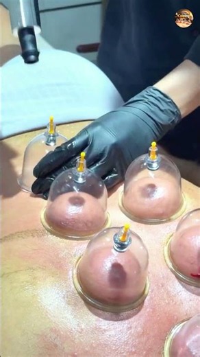 Dry Cupping Full-Body Therapy |✅ Relaxation & Recovery Techniques #asmr #drugfreeindia