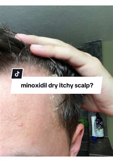 Moisturizing Tips After Using Minoxidil
