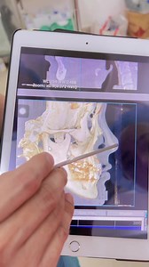 52 reactions · 25 comments | Cô Nàng Hot Girl Tik Tok Sau 5 Năm Chờ Đợi Quyết Tâm Sửa Lại Mũi Lựa Chọn Phương Pháp Sụn Sườn Fascial Chỉnh Xương Ghép Khuyết Sóng Surgiform Kết Hợp Trung Bì Đầu Mũi Lựa Chọn ThS.Bác sĩ Nguyễn Tiến Huy Là Nơi Thực Hiện Mong Ước Bấy Lâu Nay Cùng Xem Phân Tích Trước Mổ Cùng Bác Sỹ Nhé | Bác sĩ Nguyễn Tiến Huy | Facebook