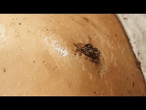 [ASMR] Armpit Blackhead Extraction – Dr. Pimple Popper’s Most Satisfying Removal Ever! 1111SS 150417
