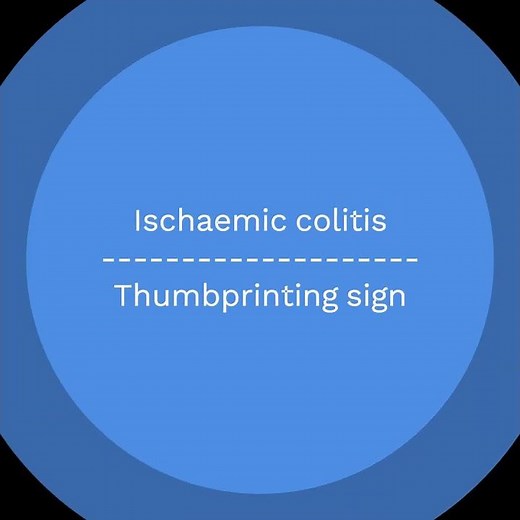 Ischaemic colitis causing small bowel ileus on Abdominal X-ray