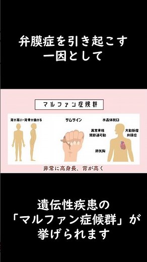マルファン症候群とは？ #shorts