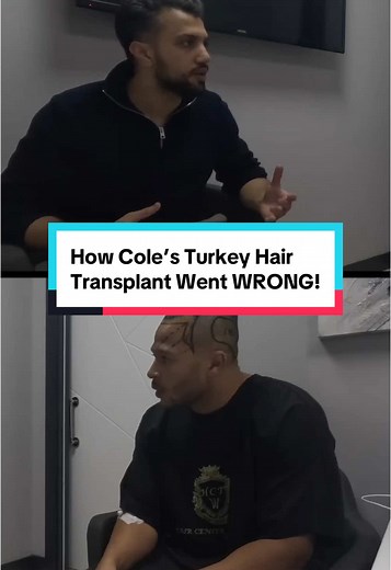 Cole's Turkey Hair Transplant Experience Review