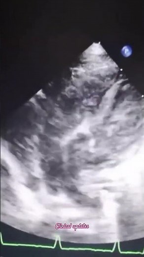 A case of transposition of great arteries TGA #cardiology #echo #heartdisease