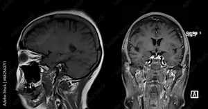 The MRI brain scan footage reveals intricate brain details, aiding in diagnostic procedures.
