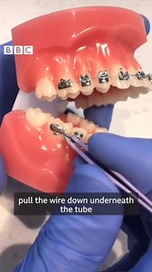 269K views · 303 reactions | Do you know someone with braces? These tips might be just what they need if their orthodontist is closed due to coronavirus. 醴 | BBC Wiltshire | Facebook
