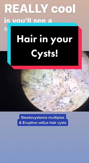 Understanding Steatocystoma Multiplex and Eruptive Vellus Hair Cysts