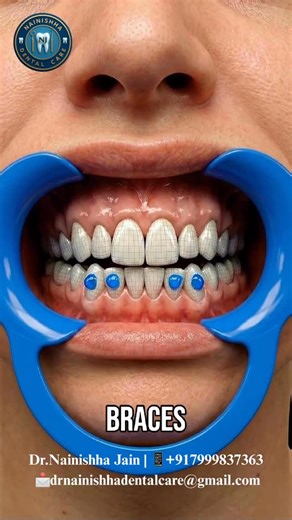Nainishha Dental Care✨🦷 | Dental braces are orthodontic devices used to straighten teeth, correct bite issues, and improve overall oral health. They’re commonly used... | Instagram