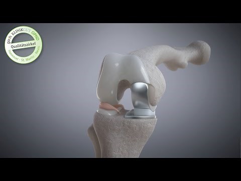 Medial osteoarthritis of the knee: Oxford partial knee replacement, sliding knee sled