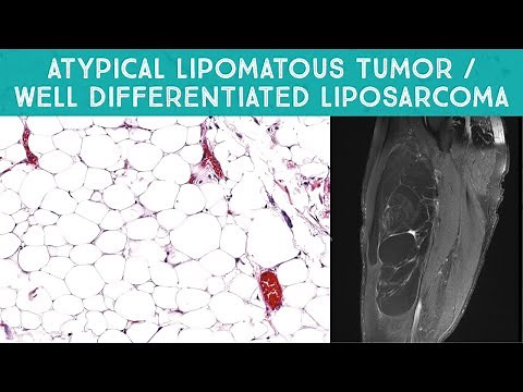 Well differentiated liposarcoma / "Atypical lipomatous tumor" mimicking lipoma (Oregon Case 13)