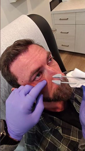 Come with me to freeze skin tags as a dermatologist