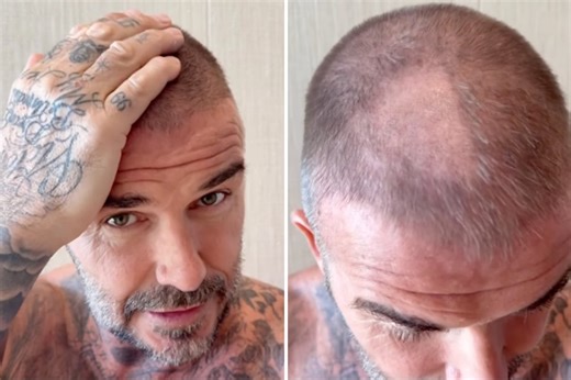 David Beckham left with bald patch after ‘terrible’ hair accident