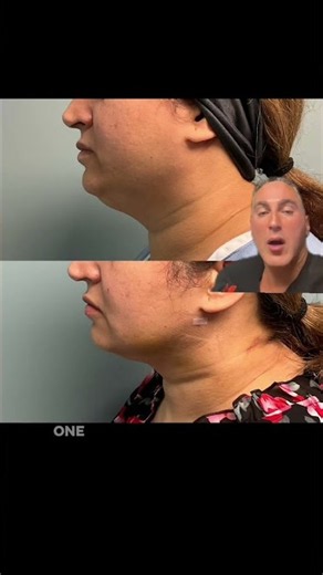 Best Way to Slim Down a Heavy Neck