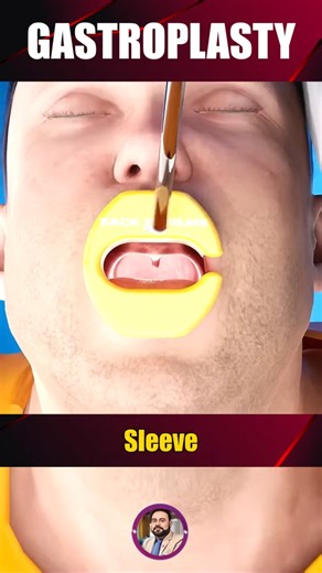 How Endoscopic Sleeve Gastroplasty (ESG) Is Performed | Non-Surgical Weight Loss #Shorts