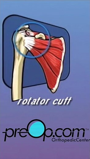 🔍 PreOp® Rotator Cuff Repair – Arthroscopic 💡Clinical Skills Made Simple✨ #shorts
