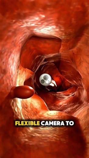 Colonoscopy procedure #colon #colonoscopyprep