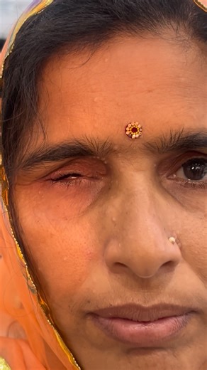 Dr Vikas Gupta, MDS (Ex PGI) | Chandigarh Facial Prosthetics | Customised artificial eye is a prosthesis like artificial teeth made up of medical grade acrylic after taking impression then carved and... | Instagram