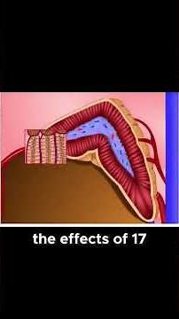 17 Alpha Hydroxylase Deficiency The Hormonal Imbalance Behind Hypertension and Hypogonadism!